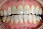 Figure 5  Pretreatment view prior to in-office whitening procedure.