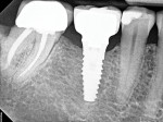 Fig 19. Radiographically at 1 year, peri-implant bone levels were stable.