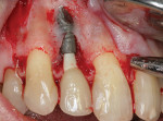 Fig 4. Removal of the apex of the dental implant and subsequent implantoplasty.