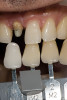 Figure 4  Application of a self-etching adhesive immediately after completion of tooth preparation.