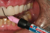 Figure 11  Enamel was etched with phosphoric acid prior to application of self-etching adhesive during cementation phase of the appointment.