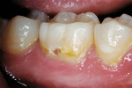 Figure 13  Caries/decalcification lesion of a permanent molar.