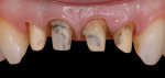 The existing restorations were removed, and the preparations were refined. After final impressions were taken with silicone, provisional restorations were fabricated and cemented with temporary cement.