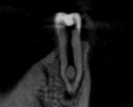 Fig 2. Coronal section of CBCT demonstrated the presence of an atypical anatomy.