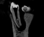 Fig 3. Sagittal section of CBCT demonstrated the presence of an atypical anatomy.