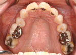 Fig 5. Pretreatment maxillary occlusal view showing previously restored teeth.