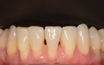 Fig 8. Pretreatment close-up frontal view of mandibular anterior teeth demonstrating mild attrition and bone loss.