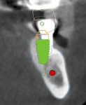 Fig 6. The implant placed in the No. 19 site was deemed unstable and removed. The green implant image represents ideal implant location.