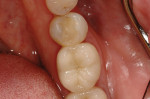 Figure 8  Final restorations (zirconia crown on tooth No. 19, two-surface composite on tooth No. 20).