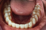 Fig 8. Post-treatment situation demonstrating
leveling and aligning of the patient’s dentition
and correction of mandibular anterior crowding.