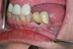 Figure 1  Cervical decay on teeth Nos. 22 and 23.