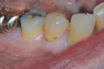 Figure 5  The same patient also presented with decay on tooth No. 28.