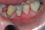Figure 8  Glass ionomer restorations using Ketac Nano restorative were placed to help impede further decay.