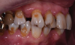 Preoperative close-up smile photograph and retracted right and left lateral close-up photographs. Note the areas of arrested cavities, dry mouth-related dental repercussions resulting from the patient’s history of radiation treatment, significant spacing issues, and discolored teeth.