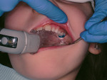 Figure 2  The tooth is isolated from the saliva of the mouth with Isolite.