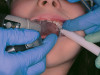 Figure 1  Radiograph demonstrating retained excess cement on abutment (see arrow).