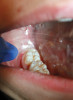 Figure 2  Clinical photograph of an implant restoration replacing the congenitally missing maxillary left lateral incisor. Note the cyanotic color changes, due to inflammation and cement, of the marginal gingiva in a 31-year-old female patient with thin biotype.