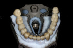Figure 5   5 PFM crowns, teeth Nos. 18 to 31 on a Lava C.O.S. SLA model illustrate the point that those changing from traditional impressions to digital are not limited to only CAD-designed, all-ceramic materials.