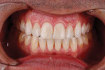 Frontal retracted view showing that orthodontic treatment closed the anterior open bite but resulted in a deep gingival embrasure to contend with during the preparation phase of the mandibular anterior teeth.