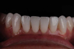 Close-up retracted view of the final mandibular anterior restorations. The use of clear aligner therapy minimized the need for preparation and the risks involved, helping the patient achieve an effortless, functionally sound smile with a favorable long-term prognosis.