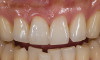 Figure 5  Defective margins. Mandibular second molar with a Class II composite resin with a defective facial–gingival margin.