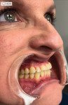 Right lateral retracted view of the patient at her crown preparation appointment. Note the severe attrition of teeth Nos. 5 through 12, abfraction lesions on teeth Nos. 6 and 11, and overjet.