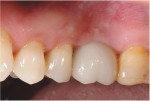 Posttreatment photograph of the definitive restoration 30 months after insertion demonstrating gingival margins and papillae in harmony with those of the surrounding dentition.
