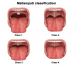 Figure 1 Mallampati classification is determined by looking at the anatomy of the oral cavity.