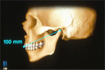 Figure 3  The functional relationship of the maxillary arch to the axis of rotation for proper function (Figure 3) and the esthetic relationship of the maxillary arch to the patient’s face for optimal esthetics (Figure 4).