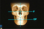 Figure 4  The functional relationship of the maxillary arch to the axis of rotation for proper function (Figure 3) and the esthetic relationship of the maxillary arch to the patient’s face for optimal esthetics (Figure 4).