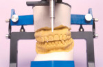 Figure 8  The face bow transfers the esthetic relationship to mount the maxillary cast into the articulator.