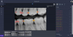 Fig 1. AI automated detection of incipient caries (yellow) and non-incipient caries (red) shown. (Image courtesy of Overjet, Inc.)