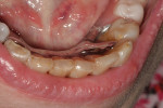 Posttreatment occlusal views of the completed minimally invasive composite restorations after finishing and polishing.