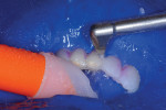 The biofilm and pellicle were removed with an abrasive slurry of aluminum trihydroxide powder and water in a high-pressure spray from both the buccal and lingual directions.