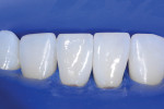 Tooth No. 24 was then injection molded, and both central incisors were shaped together.