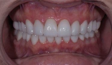 Full Mouth Rehabilitation With All-Ceramic Restorations