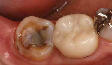 Restoring a Tooth With a Short Clinical Crown