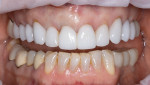 Fig 1. Before extraction, implant placement, and gap grafting of tooth No. 8.