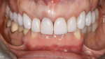 Fig 2. Close-up view of the immediate provisional in place on tooth No. 8.