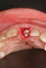 Fig 5. One-week follow-up of feldspathic porcelain veneer on tooth No. 8.
