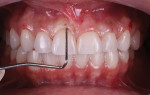 Fig 7 and Fig 8. After removal of the guide, periodontal probing was done following the CEJ and new markings as references.