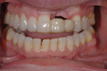 Figure 3  The incisal edge and midline position are set by tooth No. 8 and must be followed in each restoration.