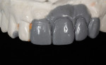 Figure 4  The diagnostic wax-up helps to create a vision for the final outcome and provides some guidelines to follow for the final restorations.