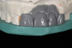 Figure 5  An incisal index is created to use as a guide for the preparations and to aid in the acrylic provisional.