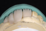 Figure 8  The incisal index and photographic information are used to cut back the acrylic structure.