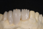 Figure 11  Ceramic stains are mixed with the composite thinning liquid, applied, and light-cured into place on the acrylic structure.