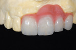 Figure 13  Composite is applied as a gingival material over the acrylic frame and light-cured into place.