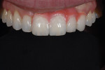 Figure 15   An intraoral image of the restoration in place. The composite 