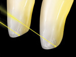 Figure 32  Most unworn incisors will exhibit a halo but not all teeth with incisal wear facets will yield the visual halo effect. The wear facet must have a buccal-facing angle.