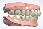 Fig 11. The designed digital dentures articulated as viewed from the right, frontal, and left.
